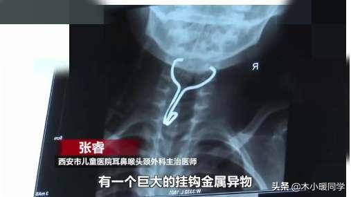 孩子误吞异物怎么办,孩子误吞异物