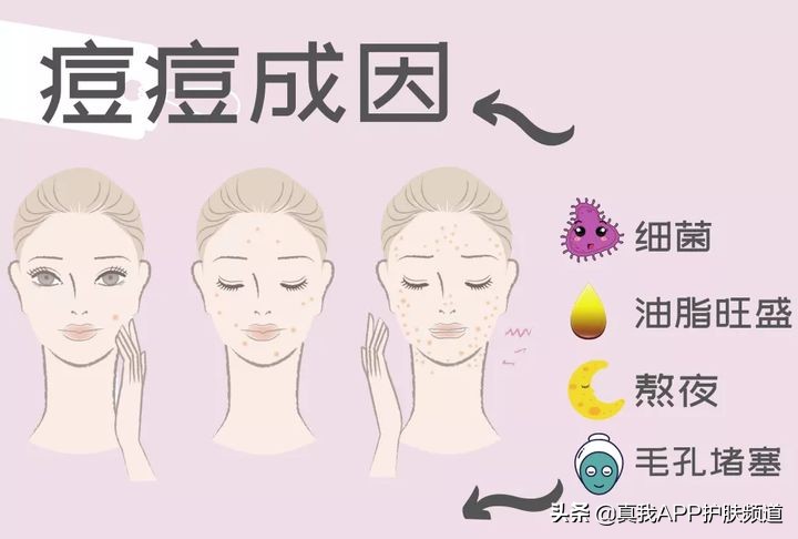 脸上长痘痘反反复复该怎么办,脸上一个部位反反复复长痘痘