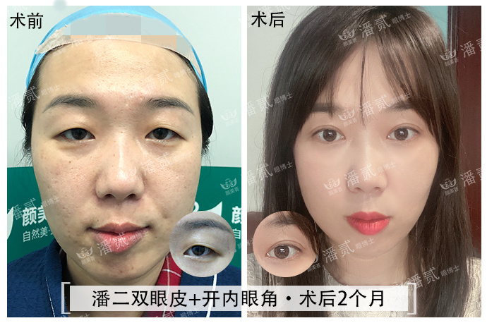 双眼皮眼尾割长了而且上扬怎么办,眼睛眼尾下垂做什么样双眼皮