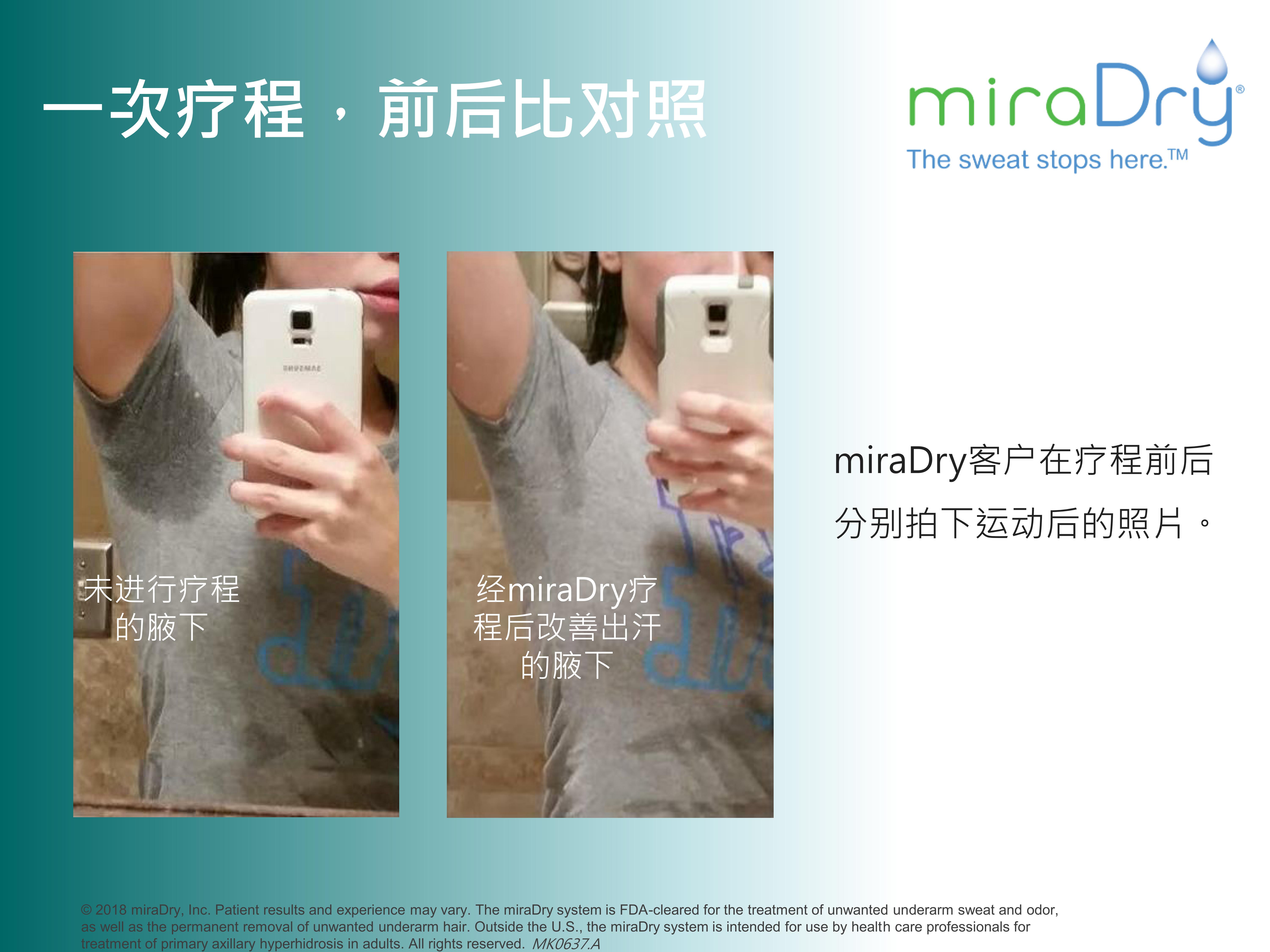 miradry微波去狐臭有效果吗,miradry治腋臭郑州哪个医院可以做
