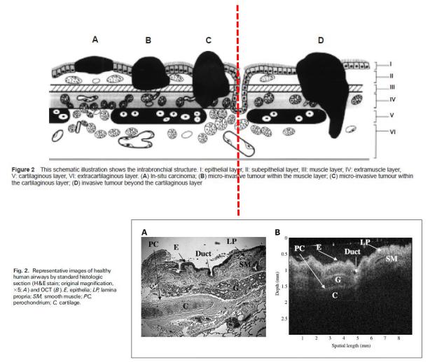 支气管镜高频电刀治疗中央型肺癌,支气管镜在早期肺癌诊断的意义
