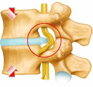 腰疼腿不疼会是椎间盘突出吗,椎间盘突出引起的腰痛怎么治
