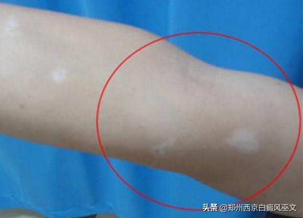 身上的白斑点怎么确定是白癜风,怎么辨别身上的斑块是不是白癜风