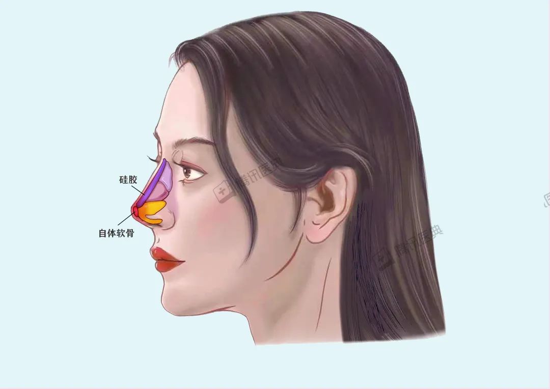 隆鼻的几大风险,隆鼻真的10个做9个后悔吗