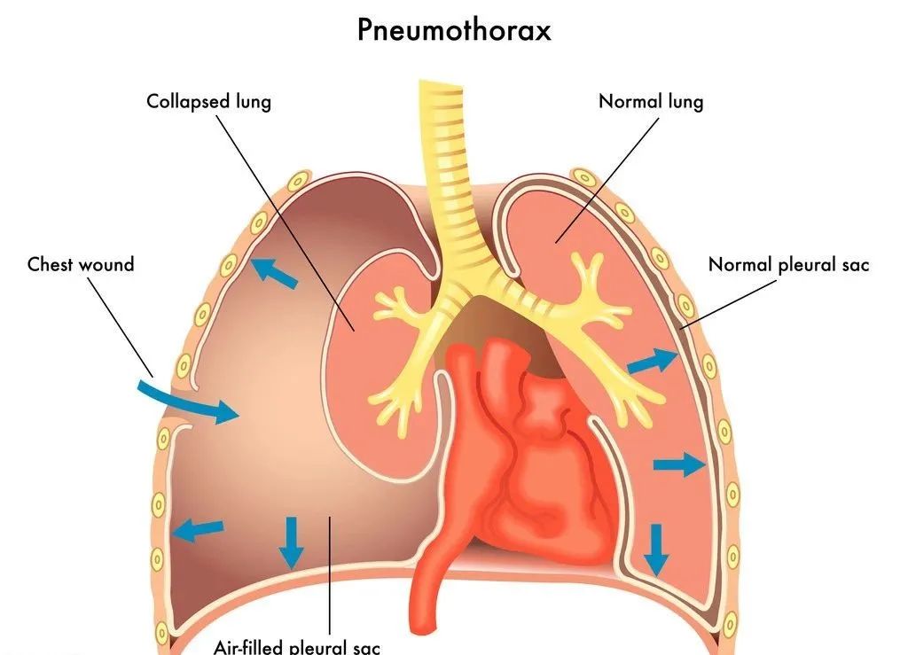 肺部疾病会引起气胸吗,肺漏气引起气胸多久能治好