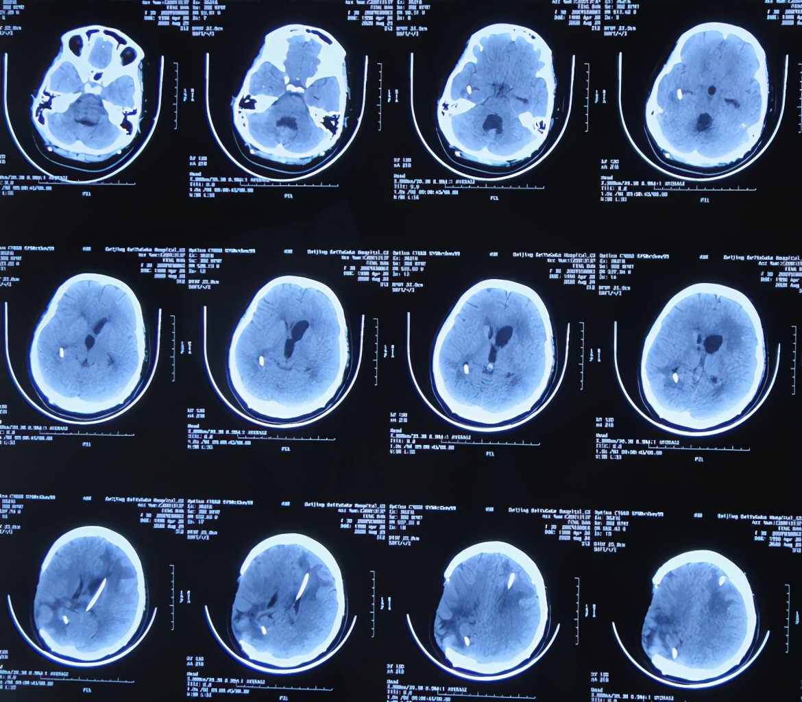 脑室有粘连脑积水有什么办法,脑动脉畸形手术后出现急性脑积水