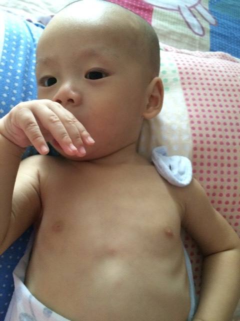 怎样预防孩子鸡胸,导致鸡胸的原因和危害