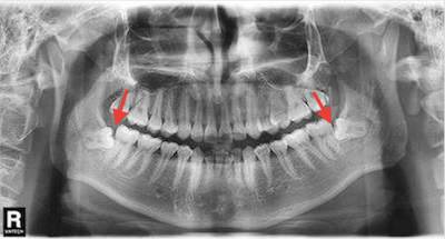为什么吃东西会把牙磕掉,为什么吃东西后会牙齿出血呢