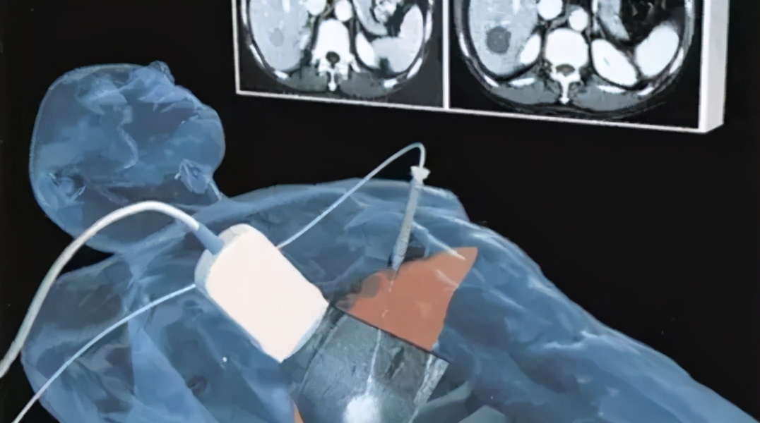 微创手术能根治肝癌,肝癌微创消融手术效果好吗知乎