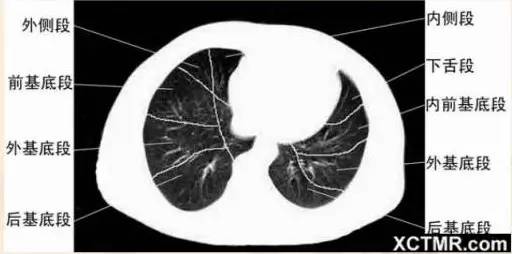 女性盆腔ct断层解剖结构图,女性盆腔脏器ct解剖