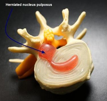 腰椎间盘突出针灸有副作用吗,腰椎间盘突出针灸越来越严重