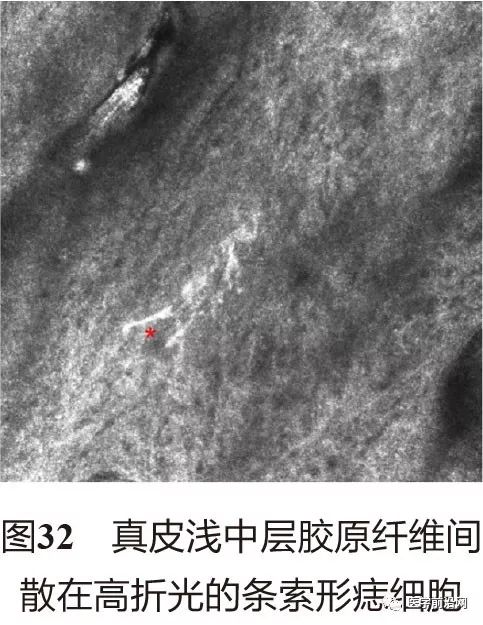 皮肤共聚焦显微镜能查什么,皮肤镜和共聚焦显微镜