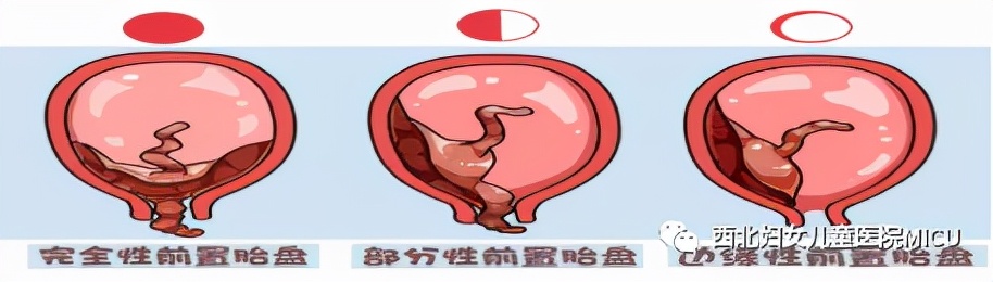 前置胎盘注意事项,前置胎盘的诊断与护理