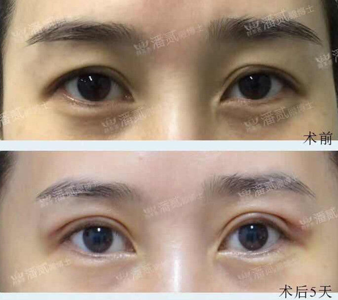自己的双眼皮太深显老怎么修复,做的双眼皮一笑有皱纹怎么修复