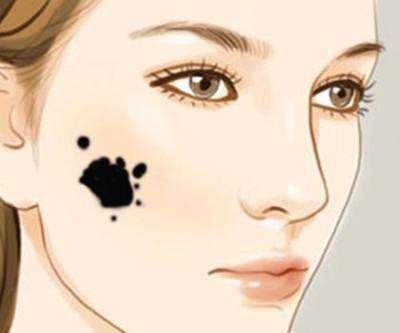 黑毛痣去除后的红印怎么去除,黑毛痣应该用什么方式才能去除