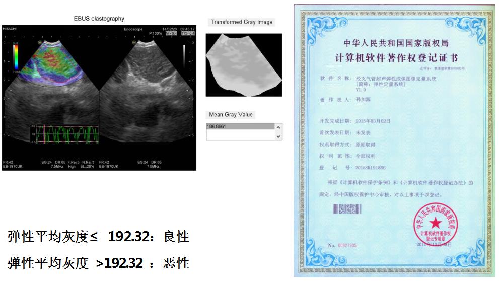 全球对肺癌治疗的最有效最新技术,肺癌的支气管镜介入治疗