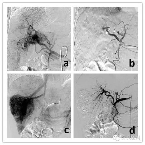 肝癌切除术后的辅助治疗选择,晚期肝癌肝硬化不能做手术怎么办