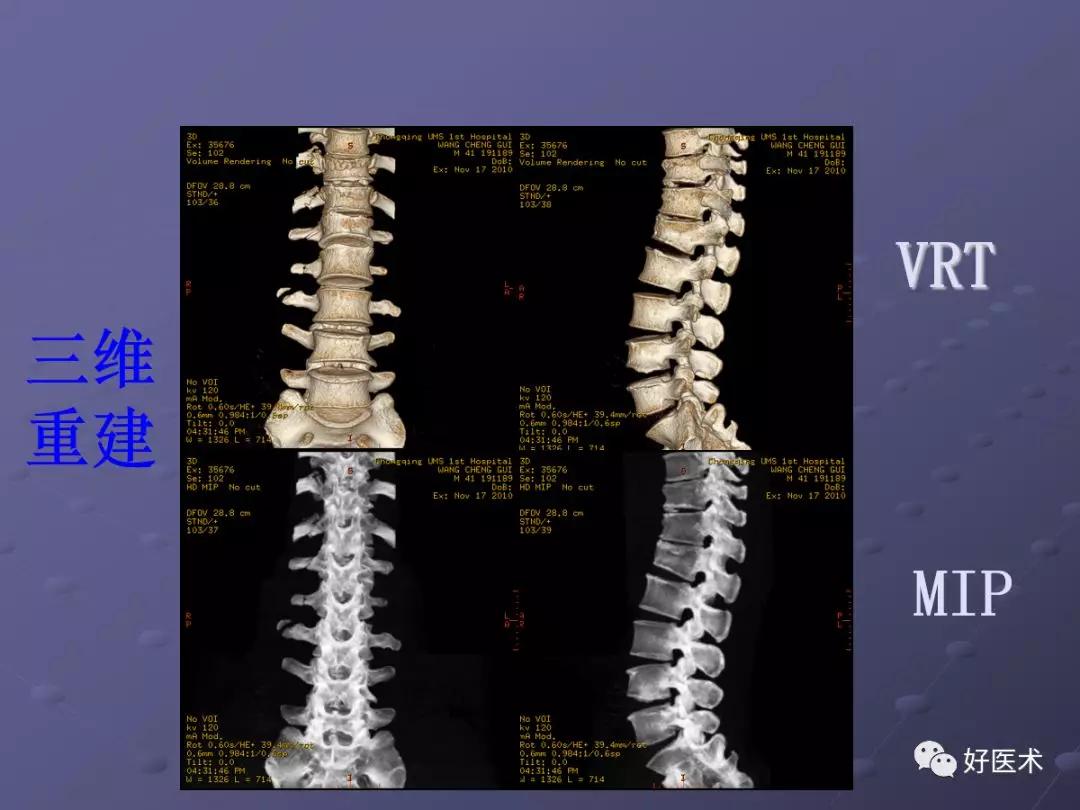 脊柱mri有哪些特点,乳腺疾病的mri诊断及鉴别