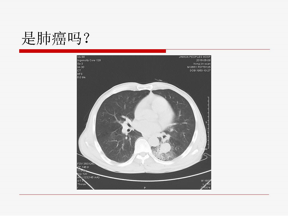 像炎症的肺癌能治好吗,医生说可能是肺癌也可能是炎症