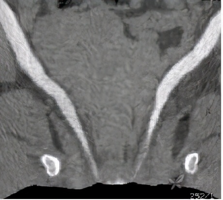 尿路梗阻导致肾积水不及时治疗,双肾积水是尿路梗阻吗