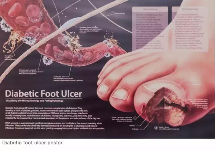 糖尿病人如何选购适合的鞋子,糖尿病患者如何选择鞋