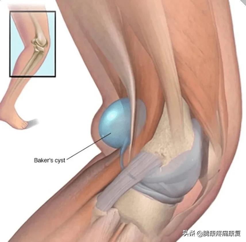 小腿疼痛的原因和治疗原则,小腿窝疼痛是什么原因造成的