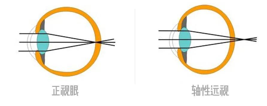 孩子远视眼怎么治疗啊,孩子远视怎么治疗