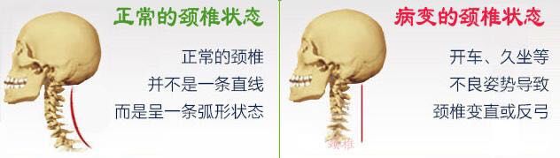 晃头颈椎有咔咔响声的危害,颈椎咔咔响是什么型颈椎病