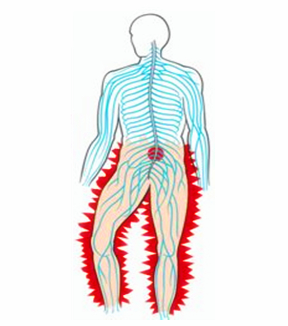 腰椎间盘突出躺在床上腿还疼,腰椎间盘突出了为什么腿会疼