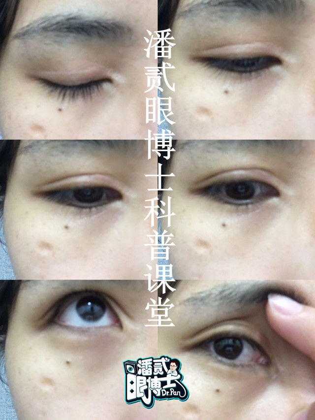 双眼皮整形的真实经历,为什么做双眼皮医生术前不沟通