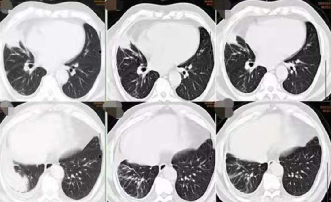 56岁男性发现双肺,56岁男性发现双肺数百个结节