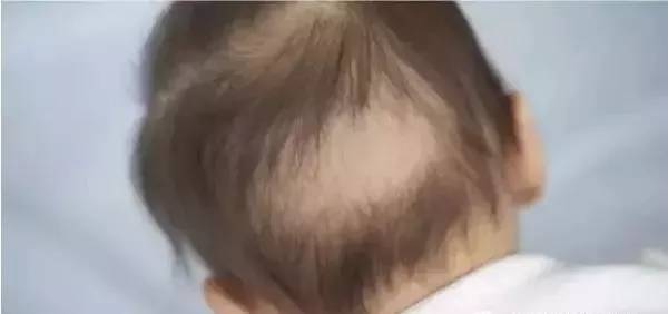 宝宝秃头怎么补救最有效,宝宝头发稀疏秃头怎么回事
