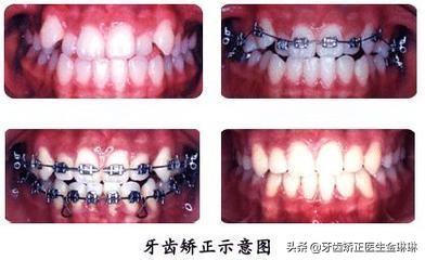 虎牙齿怎么矫正,有老虎牙怎么办