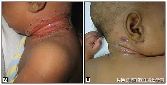 婴幼儿脖子淹了破皮了怎么办,脖子淹破皮了抹香油管用吗