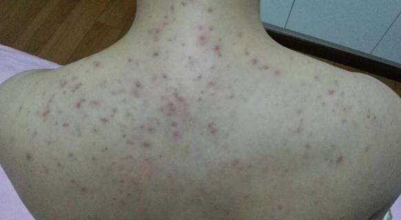 螨虫到处爬,大量螨虫