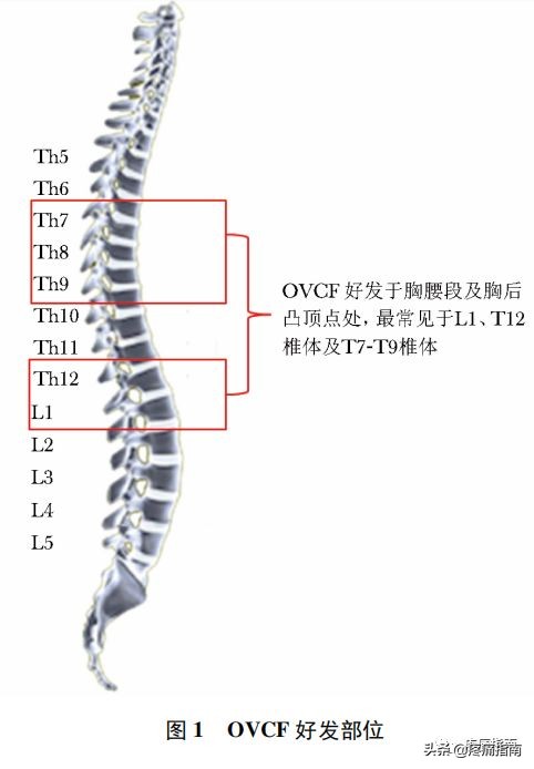 骨质疏松压缩性骨折治疗指南2022,骨质疏松性椎体压缩性骨折诊疗