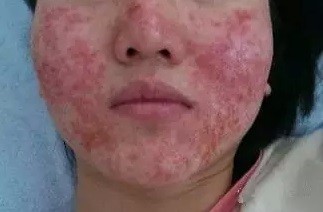 接触性皮炎的西医鉴别诊断,接触性皮炎怎么治疗才能彻底除根