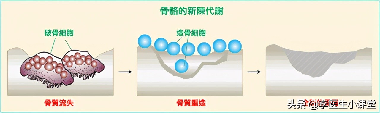 更年期骨质疏松吃什么药止疼好,骨质疏松胳膊疼痛吃什么药止疼