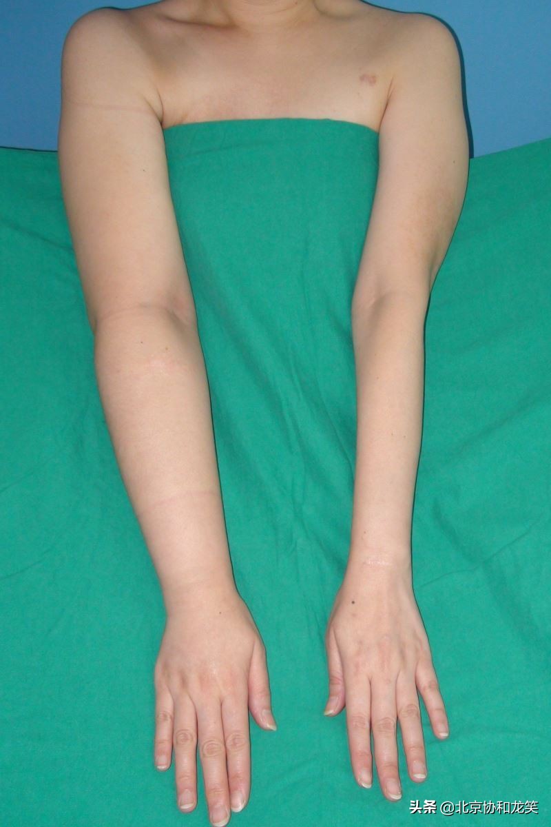 淋巴水肿哪个医院治疗最好,淋巴回流障碍性水肿怎么治疗