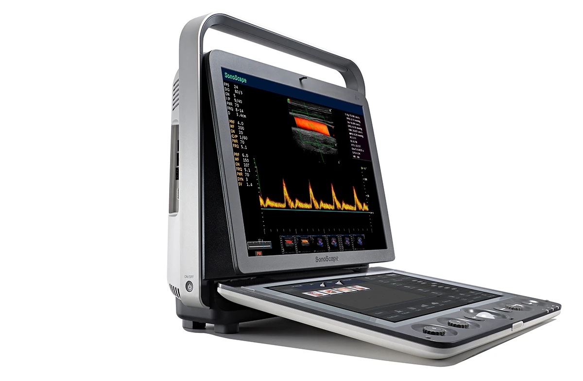 轻微宫腔粘连手术成功案例,轻度宫腔粘连分离术是大手术吗
