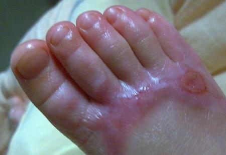 孩子发生意外烫伤的处理顺序,又被烫伤了怎么处理才有效