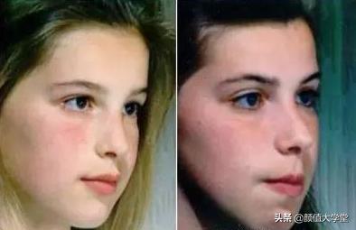 下巴后缩怎么拍侧颜,下巴后缩需要怎么矫正