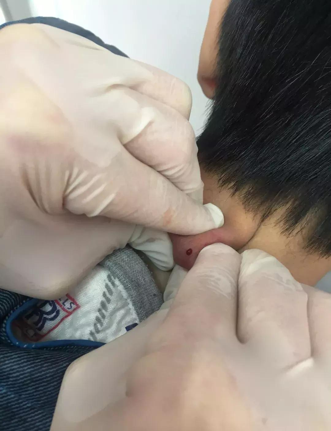 疏通经络穴位放血疗法好吗,专家建议按摩穴位