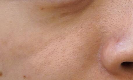 【鼻子最容易挤出这些白色的“条状物”，它到底是什么？】