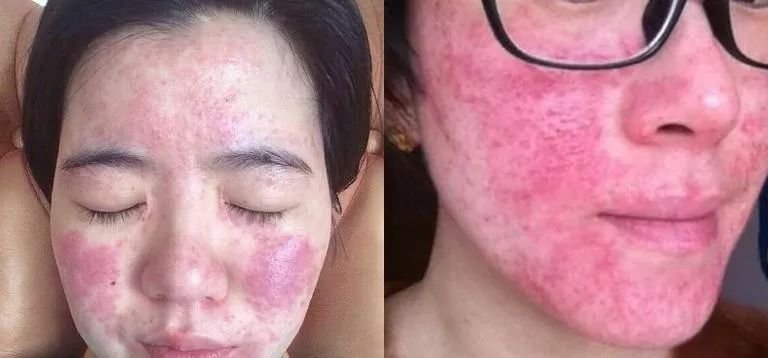 效果很快的护肤品安全吗,效果特别好的护肤品有激素吗