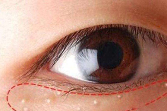 眼部周围的小点点怎么才能消除,去眼部脂肪粒的最好方法