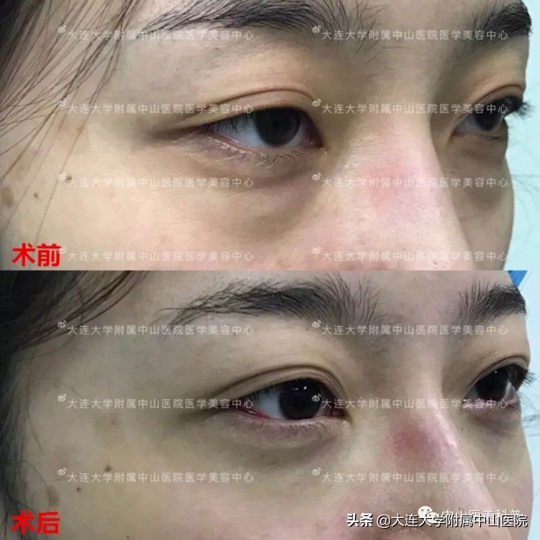 你有没有被自己的眼袋困扰过,关于眼袋的科普在这里