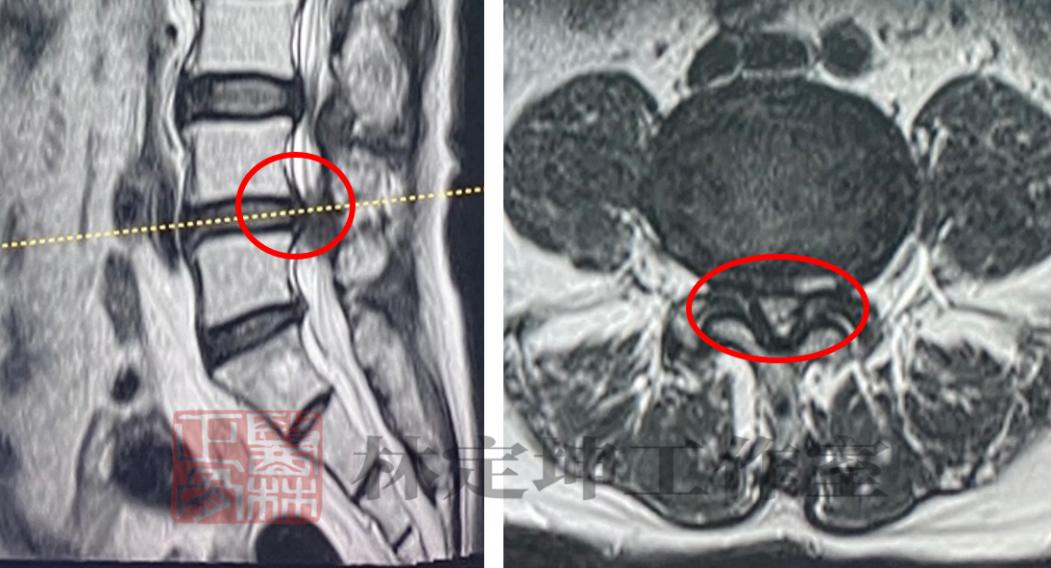 中医中药治腰椎管狭窄有什么办法,如何缓解腰椎管狭窄带来的腰腿疼