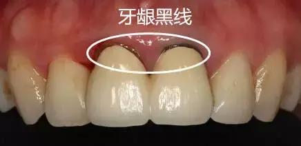 烤瓷牙瓷掉了光剩金属了有毒吗,烤瓷牙里面的金属有毒吗