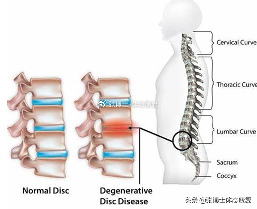 运动腰肌损伤怎么恢复,运动康复腰椎失稳